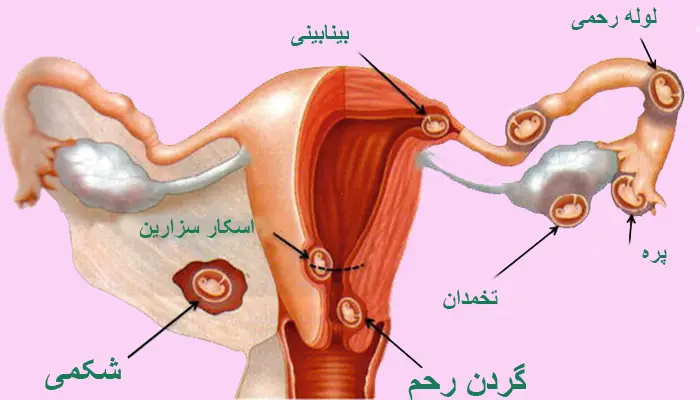 بارداری خارج رحم