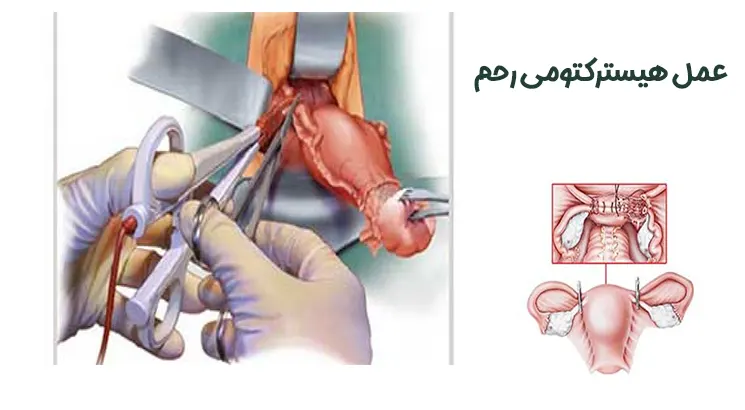 عمل هیسترکتومی رحم