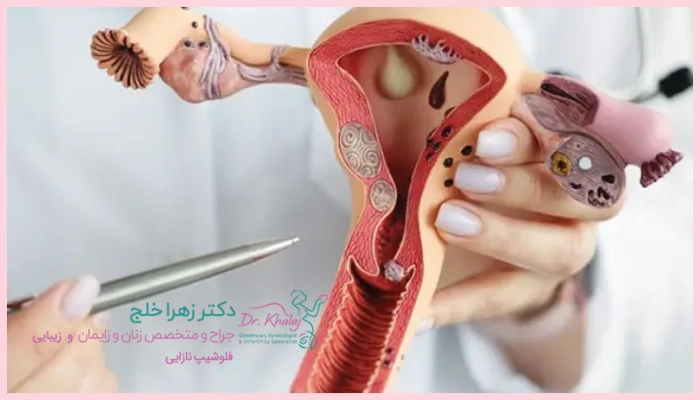 فیبروم رحم چیست؟
