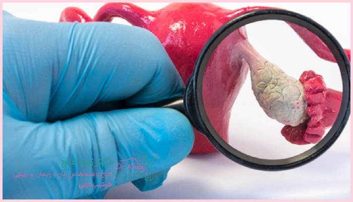 درمان پیچ خوردگی تخمدان