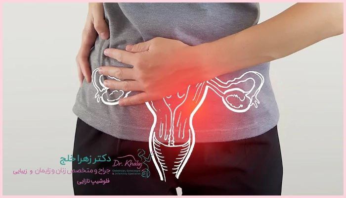 پیچ خوردگی تخمدان چیست؟