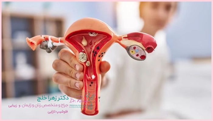 بهترین درمان برای سندروم تخمدان پلی کیستیک