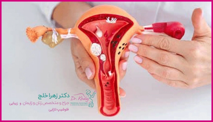 چسبندگی رحم چیست